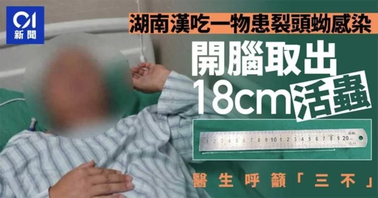 Dokter di Tiongkok Mengeluarkan Cacing Hidup Sepanjang 18 Cm dari Otak Seorang Pria