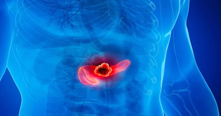 Hasil Studi Menunjukkan Resistensi Insulin Adalah Pendorong Diam-Diam Kanker Pankreas