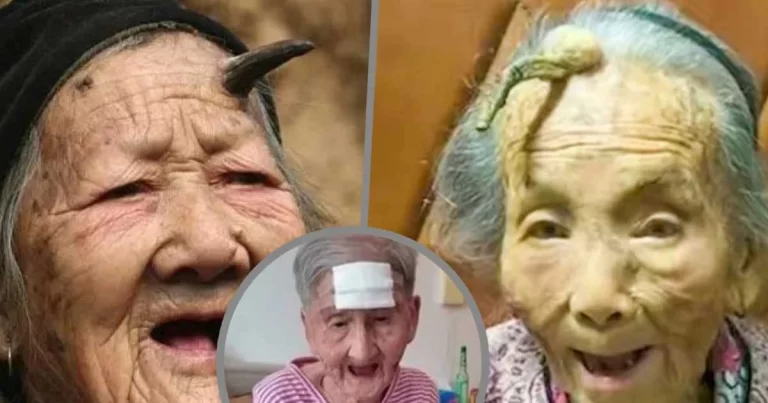 Nenek di Tiongkok Memotong ‘Tanduk Panjang Umur’ di Dahinya dengan Gunting, Membutuhkan Operasi Darurat
