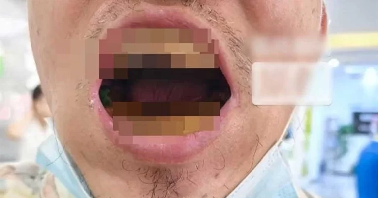 Demi Menghemat Uang, Pria di Tiongkok Membuat Gigi Palsu Sendiri dengan Bahan yang Dibeli Online, Berisiko Kehilangan Semua Giginya