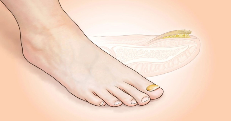Jamur Kuku Kaki : Infeksi Membandel yang Dialami 1 dari 10 Orang—Kenali Tanda-Tandanya
