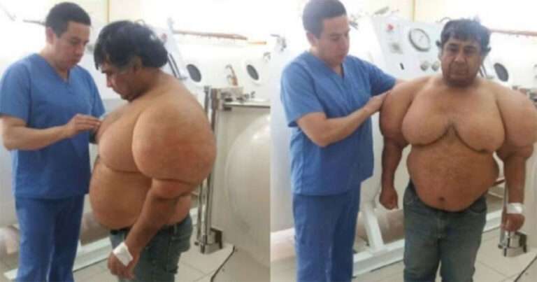 Kecelakaan Menyelam Aneh Menyebabkan Tubuh Pria Membengkak dan Dokter Tidak Tahu Cara Memperbaikinya