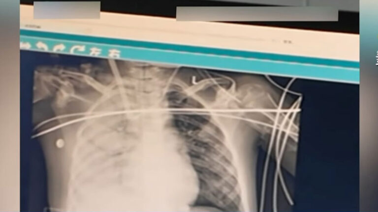 Kasus Virus Flu Tak Terbendung di Tiongkok: Beijing, Tianjin, dan Zhejiang Hentikan Kelas Belajar Hingga Viral di Medsos Tiongkok Paru-Paru Anak Kolaps dalam Waktu Singkat