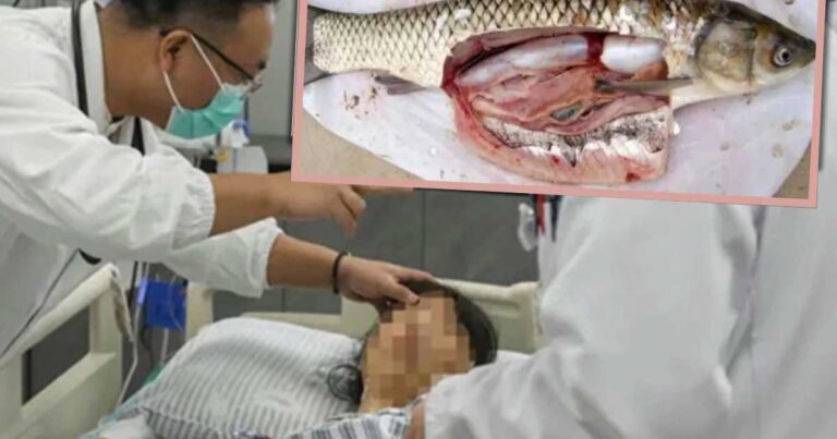 Seorang Wanita di Tiongkok Menelan Empedu Ikan Mentah dengan Harapan Meredakan Sakit Kepala, Malah Dirawat di ICU.