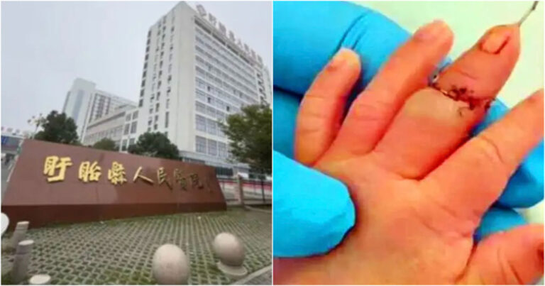 Seorang Bayi Baru Lahir di Jiangsu, Tiongkok Kehilangan Jarinya Saat Tali Pusarnya Dipotong, Sehingga Menimbulkan Kecurigaan Adanya Cedera yang Disengaja