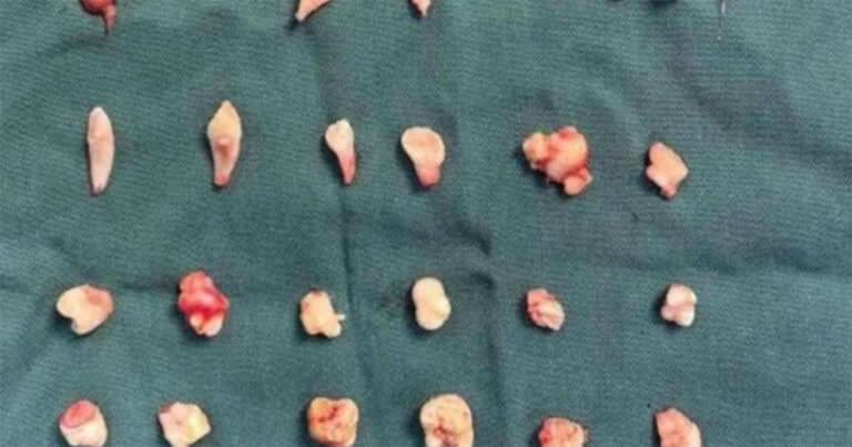 Gadis 18 Tahun Tiba-tiba Alami Sakit Perut, Ditemukan Tumor 12 cm Berisi 24 Gigi