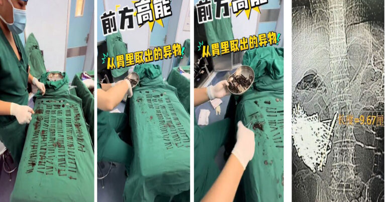 Mengerikan! Pria di Yunnan, Tiongkok Mengeluarkan 180 Paku dari Lambung, Berat Total Lebih dari 1 Kilogram 